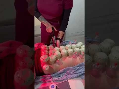 Chiropractic Adjustment +Acupuncture + Cupping Therapy! Part 2