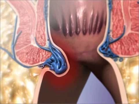 Hemorrhoids: Learn@Visible Body