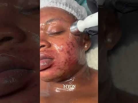 Advanced acne facial with chemical peel. #nyonderma #acne #chemicalpeeling #facial #asmr
