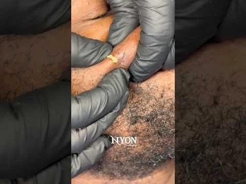 Extraction of pimples and whiteheads .  #asmr #acne #skincare #nyonderma #fyp